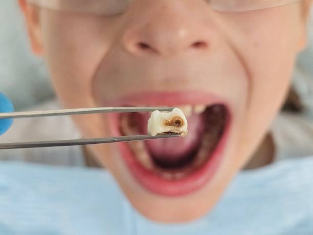 Best Emergency Tooth Extraction in Enetai, WA
